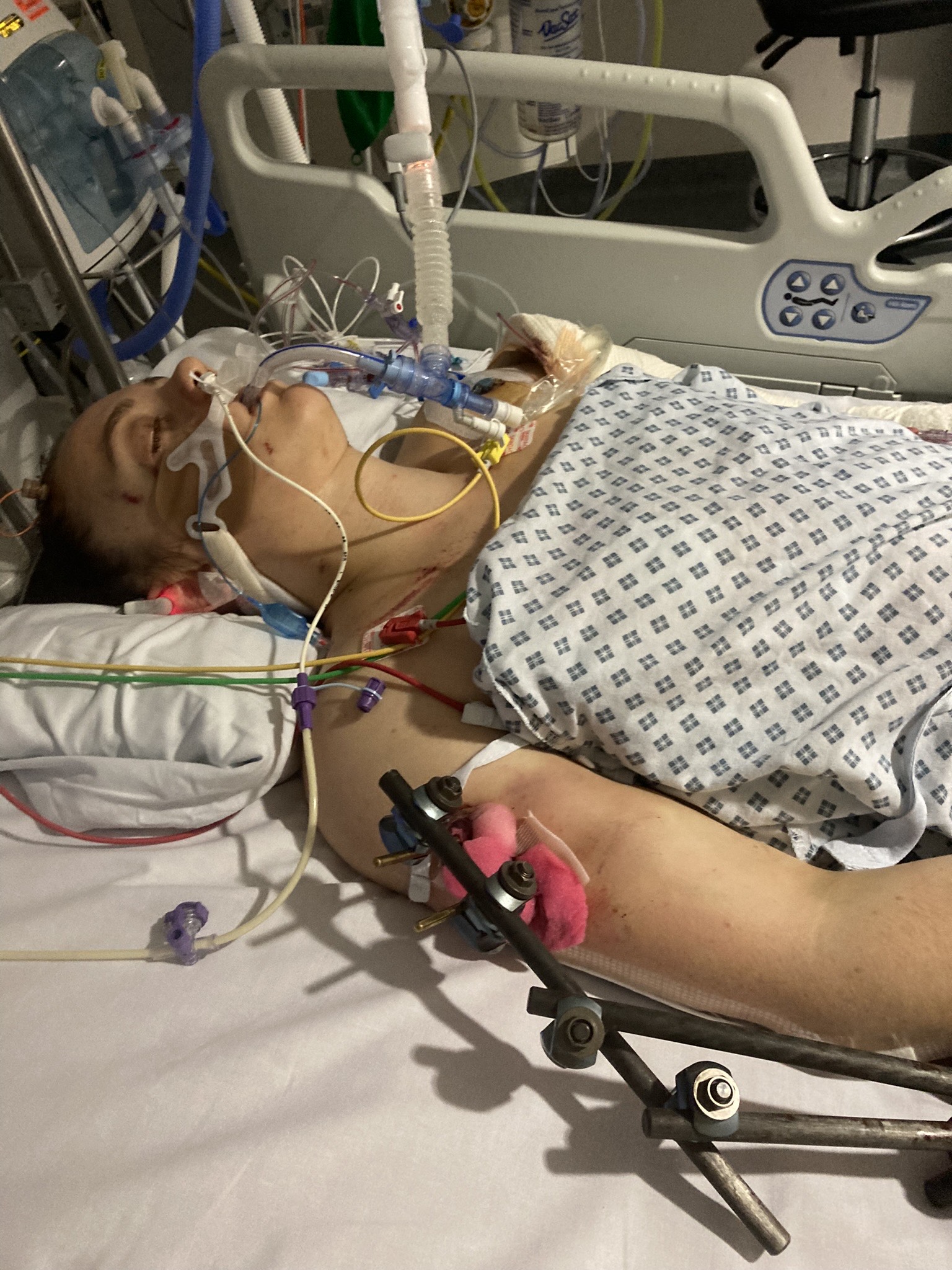 Rachel Downes in a coma