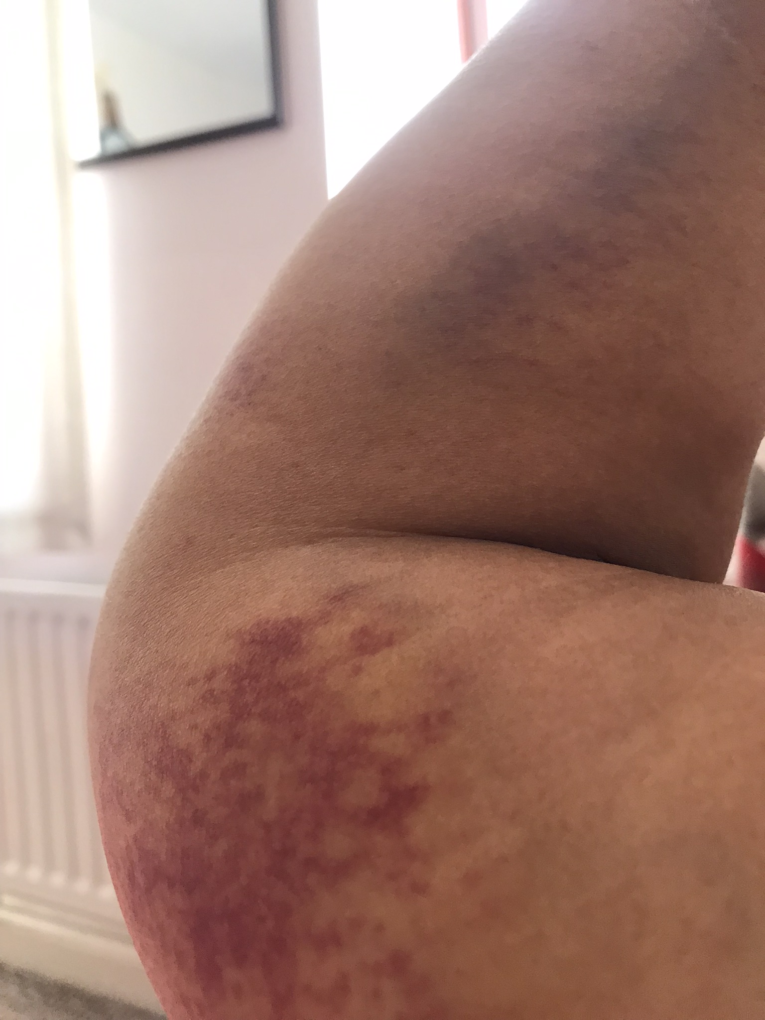 dog attack injuries